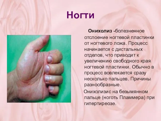 Ногти Онихолиз -болезненное отслоение ногтевой пластинки от ногтевого ложа. Процесс начинается с