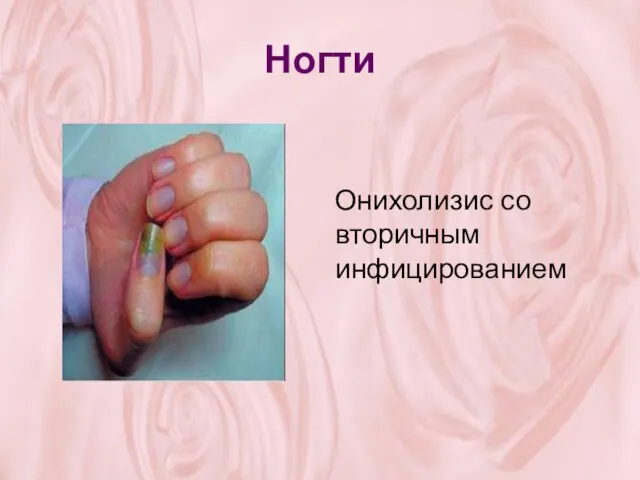 Ногти Онихолизис со вторичным инфицированием