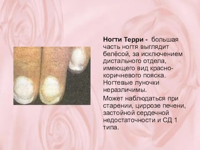 Ногти Терри - большая часть ногтя выглядит белёсой, за исключением дистального отдела,