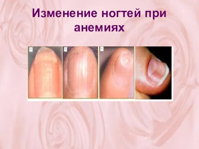 Изменение ногтей при анемиях
