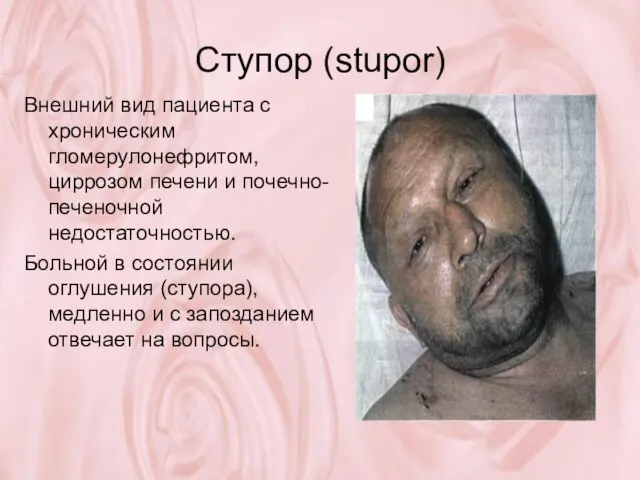 Ступор (stupor) Внешний вид пациента с хроническим гломерулонефритом, циррозом печени и почечно-печеночной
