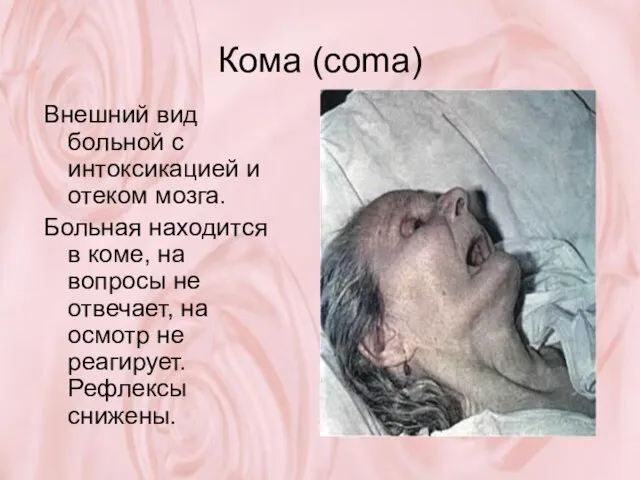 Кома (coma) Внешний вид больной с интоксикацией и отеком мозга. Больная находится
