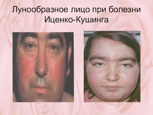 Лунообразное лицо при болезни Иценко-Кушинга