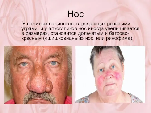 Нос У пожилых пациентов, страдающих розовыми угрями, и у алкоголиков нос иногда