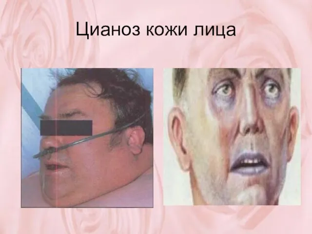 Цианоз кожи лица