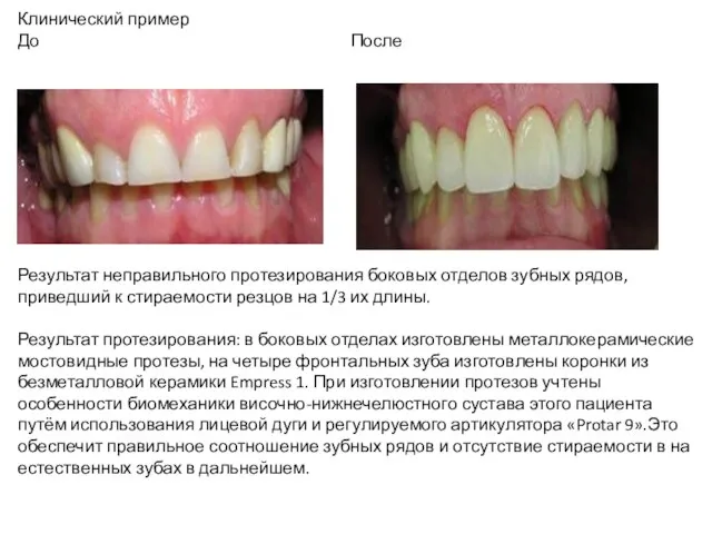 Клинический пример До После Результат неправильного протезирования боковых отделов зубных рядов, приведший