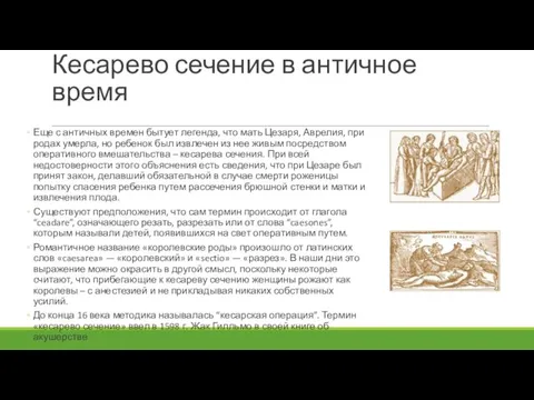 Кесарево сечение в античное время Еще с античных времен бытует легенда, что