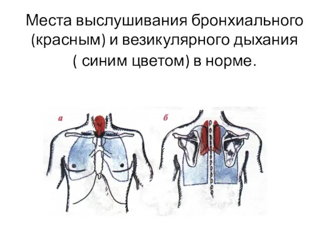 Места выслушивания бронхиального (красным) и везикулярного дыхания ( синим цветом) в норме.