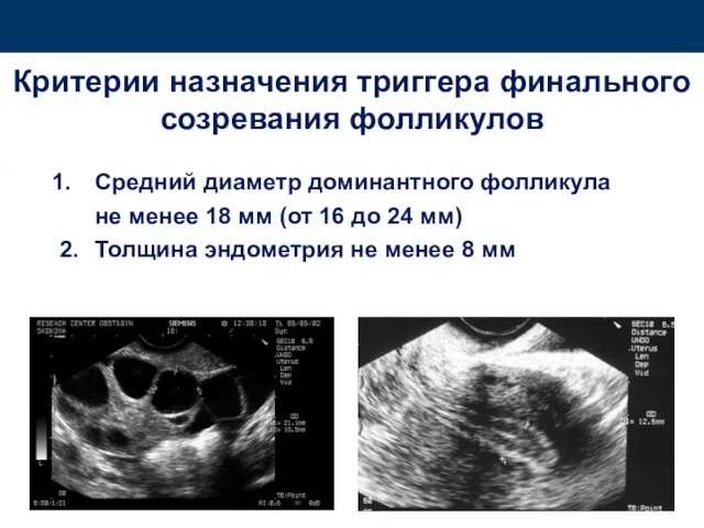 Критерии назначения триггера финального созревания фолликулов Средний диаметр доминантного фолликула не менее