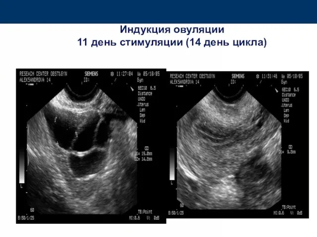 Индукция овуляции 11 день стимуляции (14 день цикла)