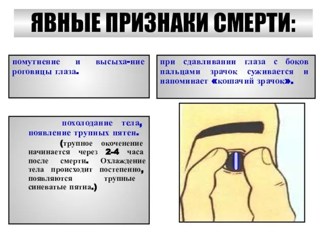 ЯВНЫЕ ПРИЗНАКИ СМЕРТИ: при сдавливании глаза с боков пальцами зрачок суживается и