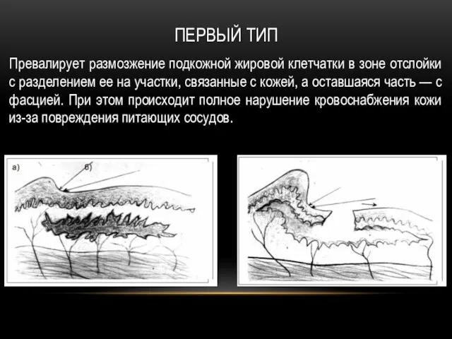 ПЕРВЫЙ ТИП Превалирует размозжение подкожной жировой клетчатки в зоне отслойки с разделением