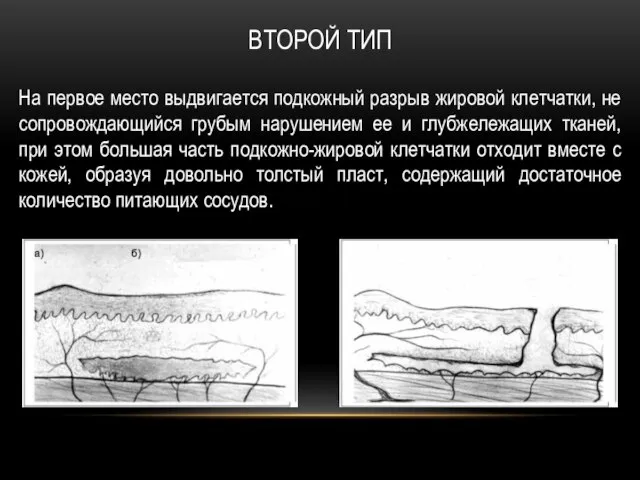 ВТОРОЙ ТИП На первое место выдвигается подкожный разрыв жировой клетчатки, не сопровождающийся