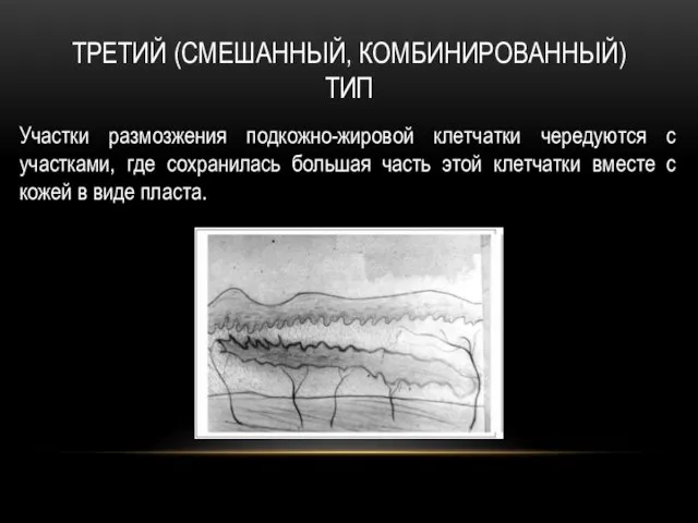 ТРЕТИЙ (СМЕШАННЫЙ, КОМБИНИРОВАННЫЙ) ТИП Участки размозжения подкожно-жировой клетчатки чередуются с участками, где