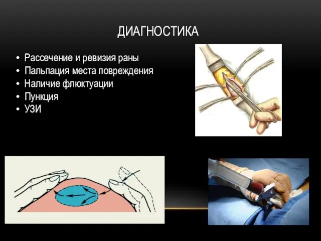 ДИАГНОСТИКА Рассечение и ревизия раны Пальпация места повреждения Наличие флюктуации Пункция УЗИ