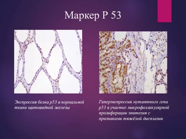 Маркер Р 53 Экспрессия белка р53 в нормальной ткани щитовидной железы Гиперэкспрессия