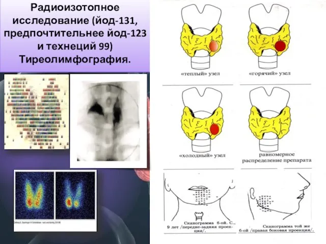 Радиоизотопное исследование (йод-131, предпочтительнее йод-123 и технеций 99) Тиреолимфография.