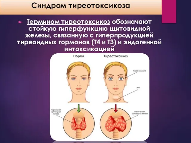 Синдром тиреотоксикоза Термином тиреотоксикоз обозначают стойкую гиперфункцию щитовидной железы, связанную с гиперпродукцией