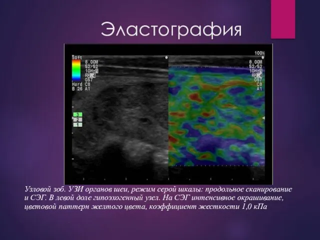 Эластография Узловой зоб. УЗИ органов шеи, режим серой шкалы: продольное сканирование и