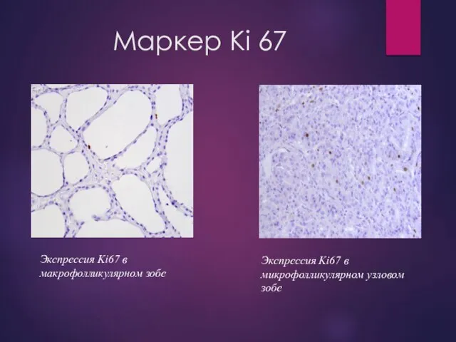 Маркер Ki 67 Экспрессия Ki67 в макрофолликулярном зобе Экспрессия Ki67 в микрофолликулярном узловом зобе