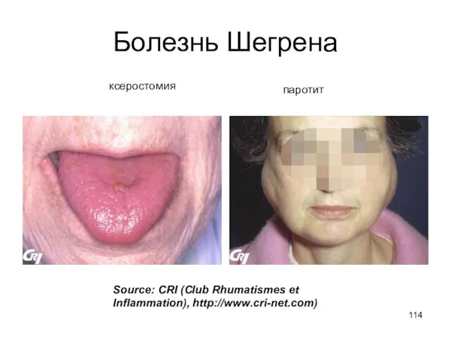 Болезнь Шегрена Source: CRI (Club Rhumatismes et Inflammation), http://www.cri-net.com) ксеростомия паротит