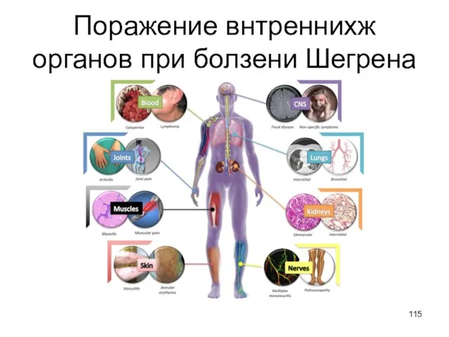 Поражение внтреннихж органов при болзени Шегрена