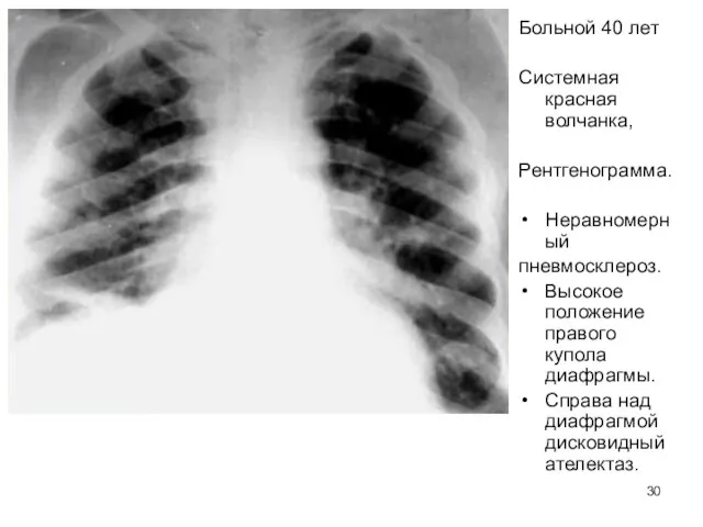 Больной 40 лет Системная красная волчанка, Рентгенограмма. Неравномерный пневмосклероз. Высокое положение правого