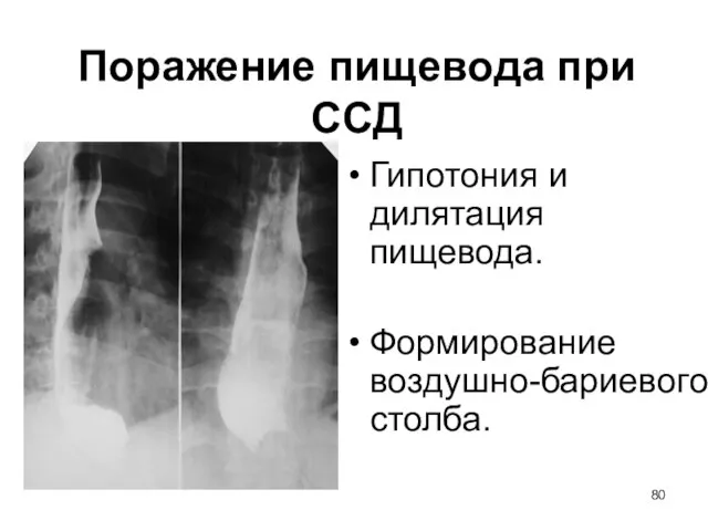 Поражение пищевода при ССД Гипотония и дилятация пищевода. Формирование воздушно-бариевого столба.