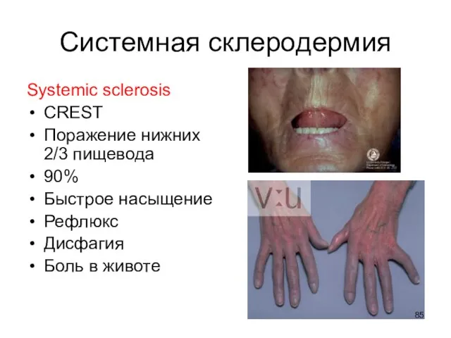 Системная склеродермия Systemic sclerosis CREST Поражение нижних 2/3 пищевода 90% Быстрое насыщение