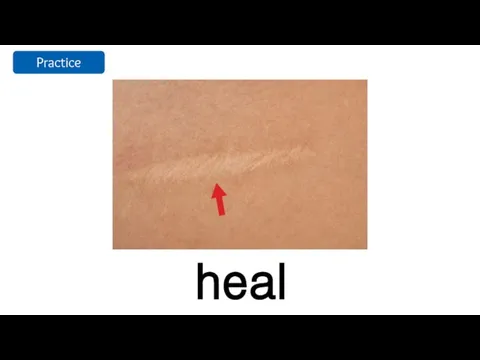 heal