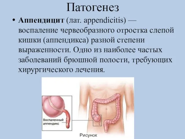 Патогенез Аппендицит (лат. appendicitis) — воспаление червеобразного отростка слепой кишки (аппендикса) разной