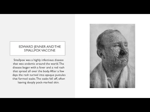 EDWARD JENNER AND THE SMALLPOX VACCINE Smallpox was a highly infectious disease