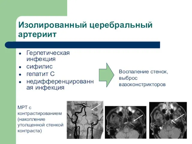 Изолированный церебральный артериит Герпетическая инфекция сифилис гепатит С недифференцированная инфекция Воспаление стенок,