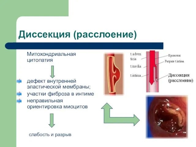 Диссекция (расслоение) Митохондриальная цитопатия дефект внутренней эластической мембраны; участки фиброза в интиме