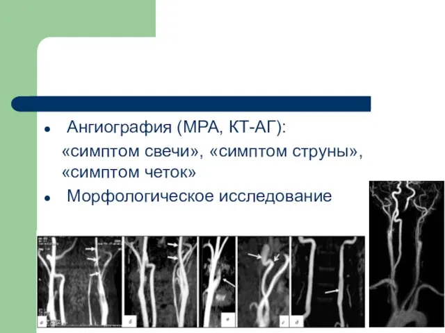 Ангиография (МРА, КТ-АГ): «симптом свечи», «симптом струны», «симптом четок» Морфологическое исследование