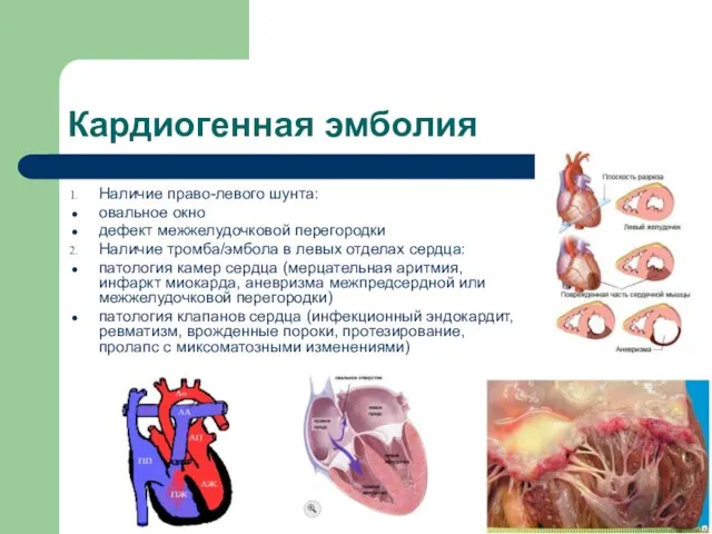 Кардиогенная эмболия Наличие право-левого шунта: овальное окно дефект межжелудочковой перегородки Наличие тромба/эмбола