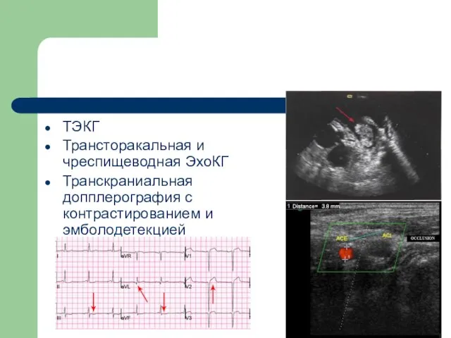 ТЭКГ Трансторакальная и чреспищеводная ЭхоКГ Транскраниальная допплерография с контрастированием и эмболодетекцией