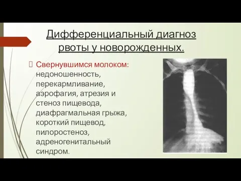 Дифференциальный диагноз рвоты у новорожденных. Свернувшимся молоком: недоношенность, перекармливание, аэрофагия, атрезия и