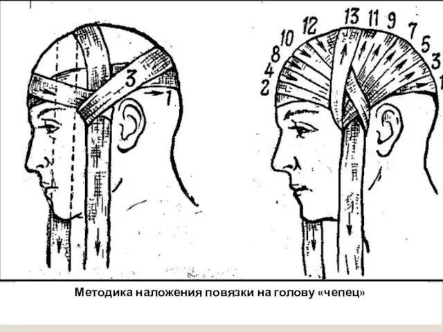 Методика наложения повязки на голову «чепец»