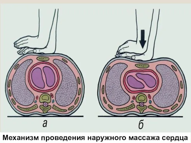 Механизм проведения наружного массажа сердца