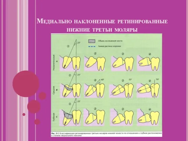 Медиально наклоненные ретинированные нижние третьи моляры