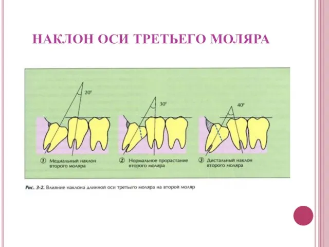 НАКЛОН ОСИ ТРЕТЬЕГО МОЛЯРА