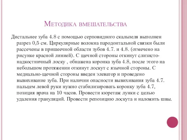 Методика вмешательства Дистальнее зуба 4.8 с помощью серповидного скальпеля выполнен разрез 0,5