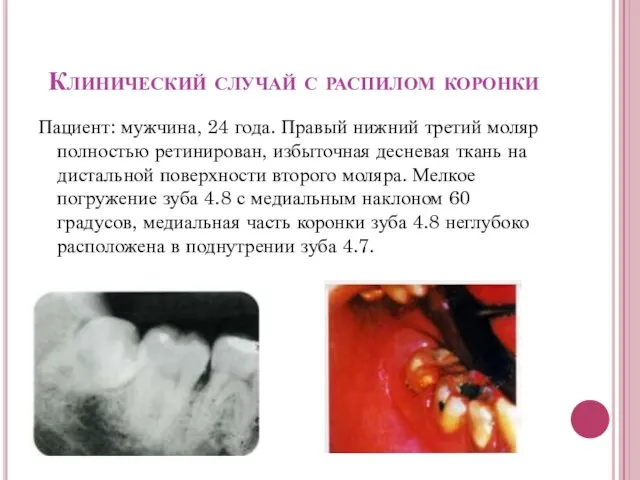 Клинический случай с распилом коронки Пациент: мужчина, 24 года. Правый нижний третий