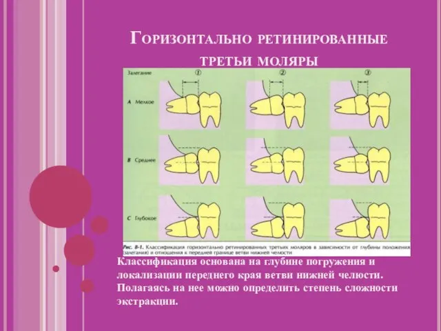 Горизонтально ретинированные третьи моляры Классификация основана на глубине погружения и локализации переднего