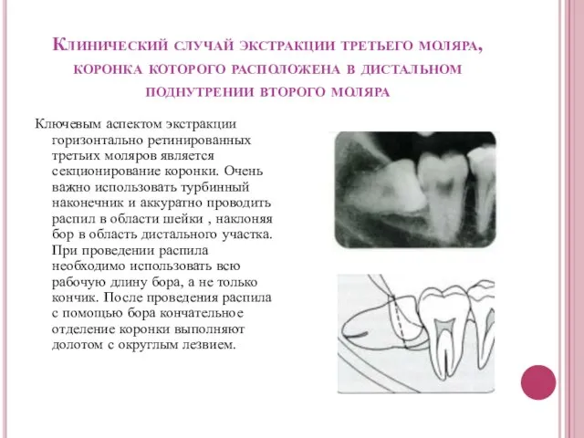 Клинический случай экстракции третьего моляра, коронка которого расположена в дистальном поднутрении второго