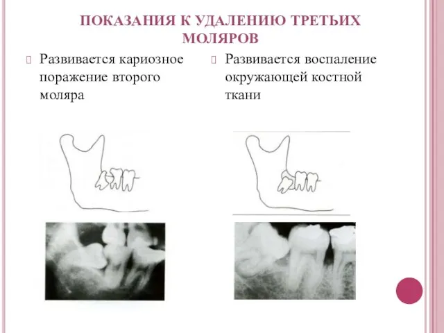 Развивается кариозное поражение второго моляра Развивается воспаление окружающей костной ткани ПОКАЗАНИЯ К УДАЛЕНИЮ ТРЕТЬИХ МОЛЯРОВ