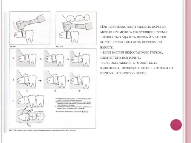 При невозможности удалить коронку можно применить следующие приемы: -полностью удалить щечный участок