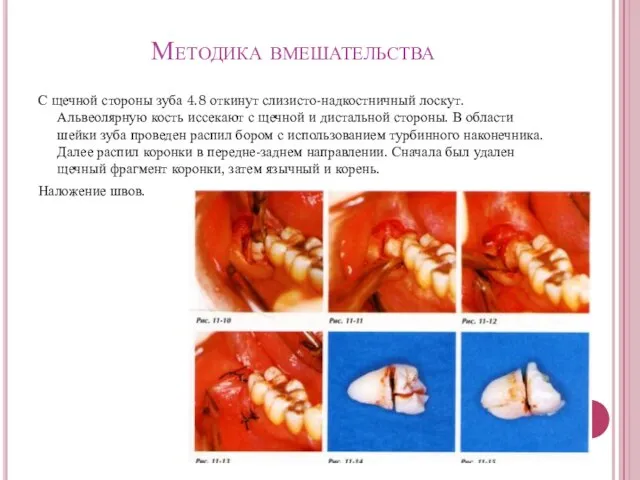 Методика вмешательства С щечной стороны зуба 4.8 откинут слизисто-надкостничный лоскут. Альвеолярную кость