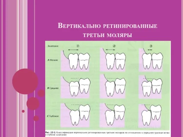 Вертикально ретинированные третьи моляры